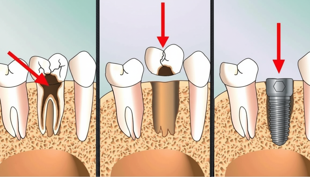 Что такое одномоментная имплантация зубов