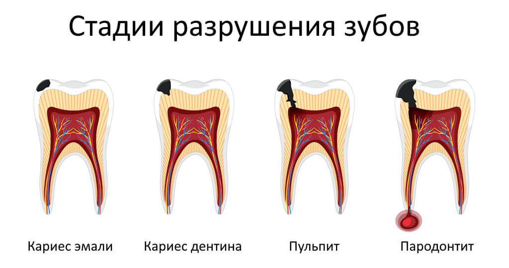 стадии кариеса