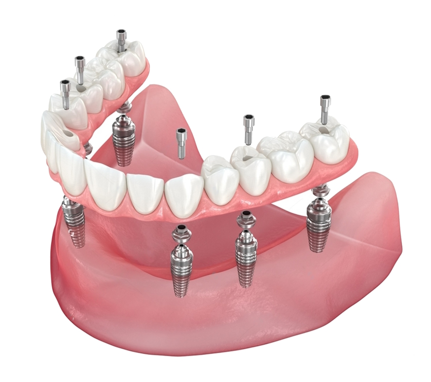 имплантация все на 6