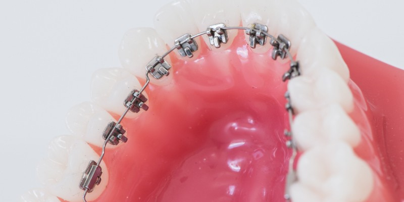 Лингвальная брекет система