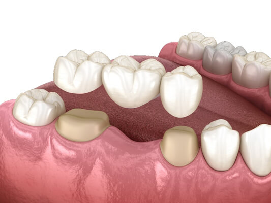 зубной мост