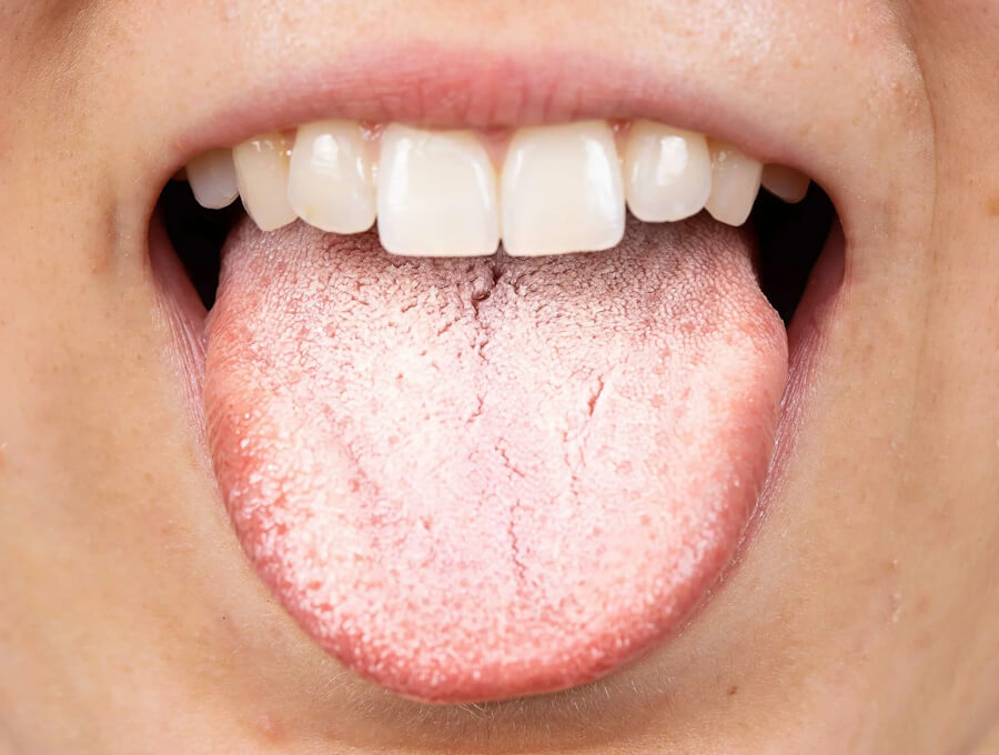 налет на языке