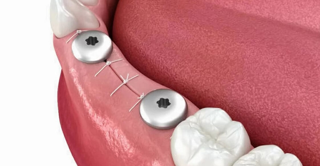 Формирователь десны над имплантатом