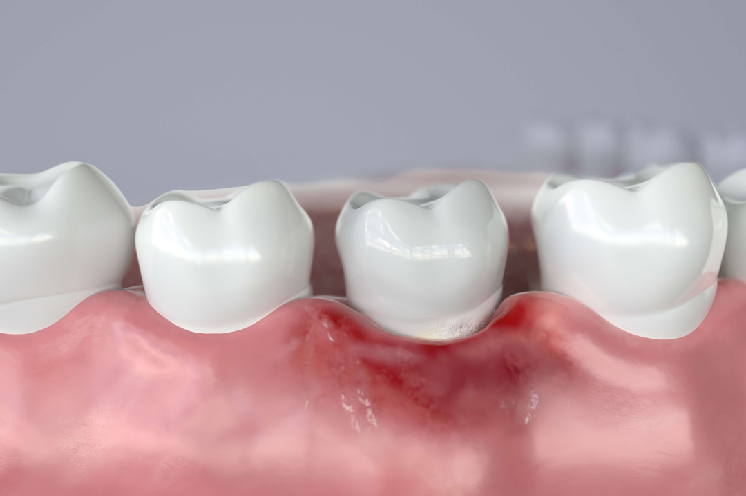 Симптомы отторжения зубного импланта