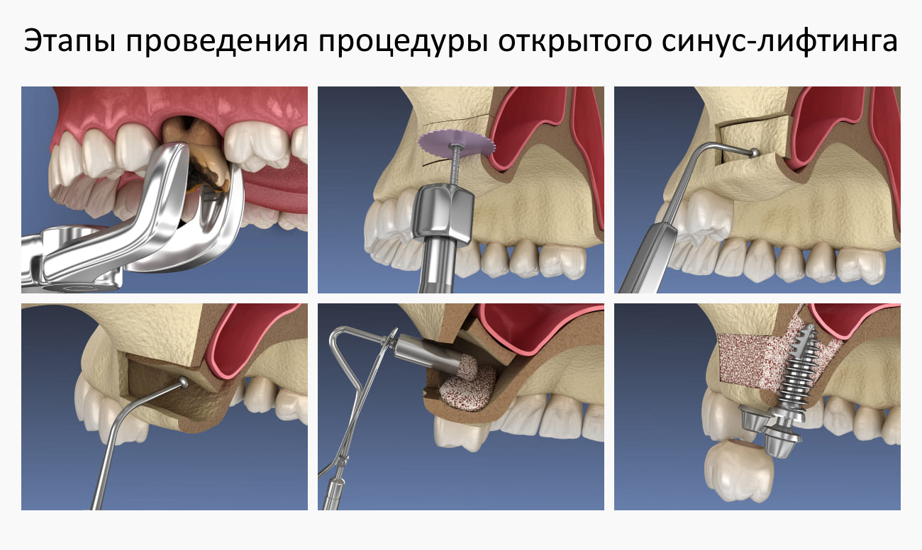 этапы проведения синус лифтинга