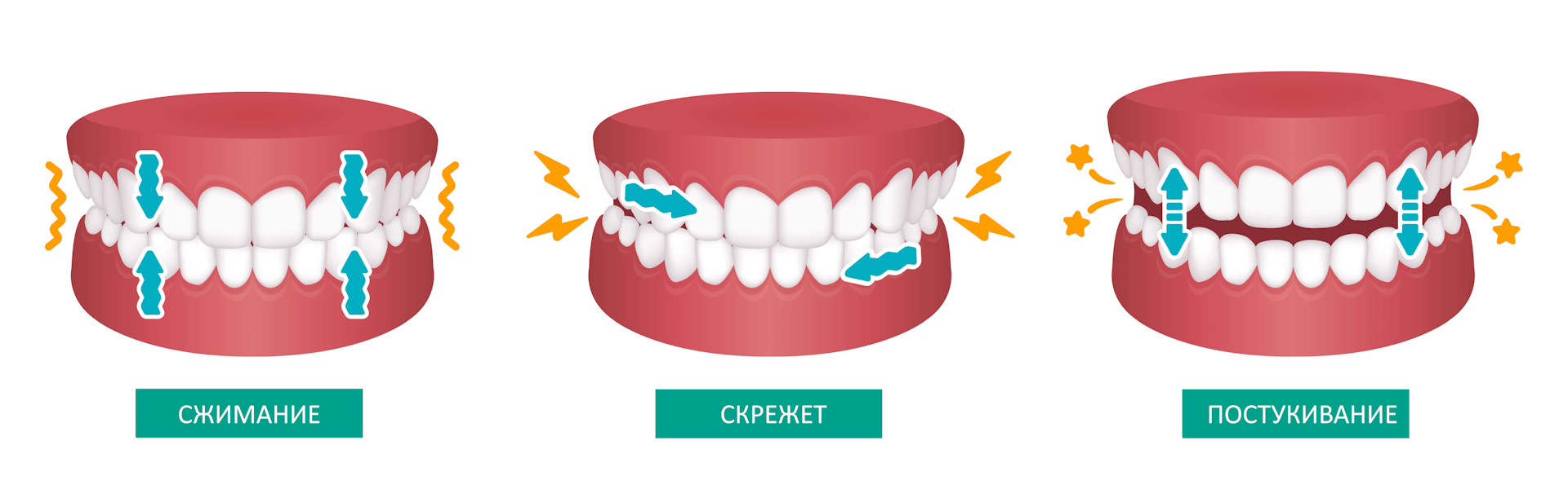 виды бруксизма