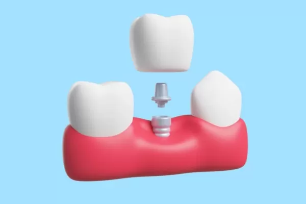 Этапы имплантации зубов