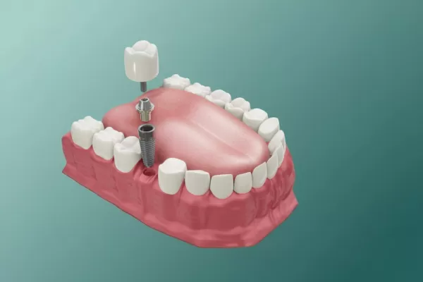 одномоментной имплантации