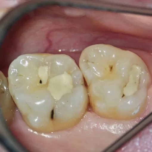 до - зубы с кариесом