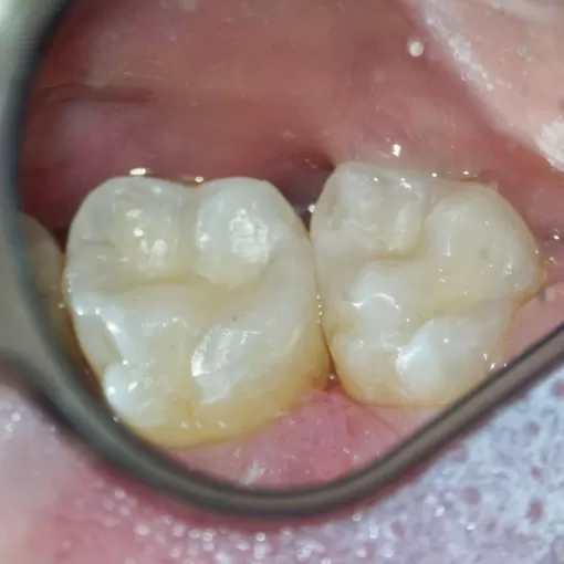 после - зубы без кариеса